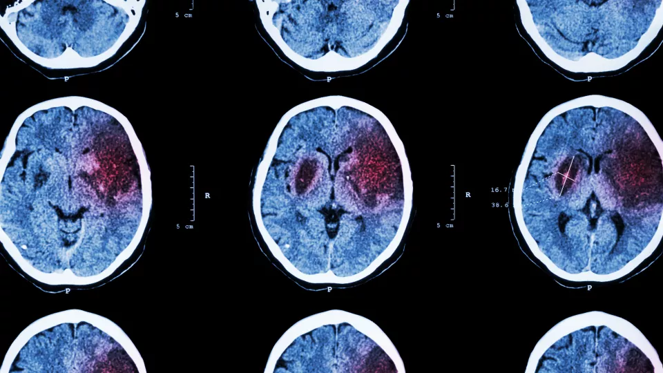 Bild på röntgade huvuden där skador av stroke syns. 